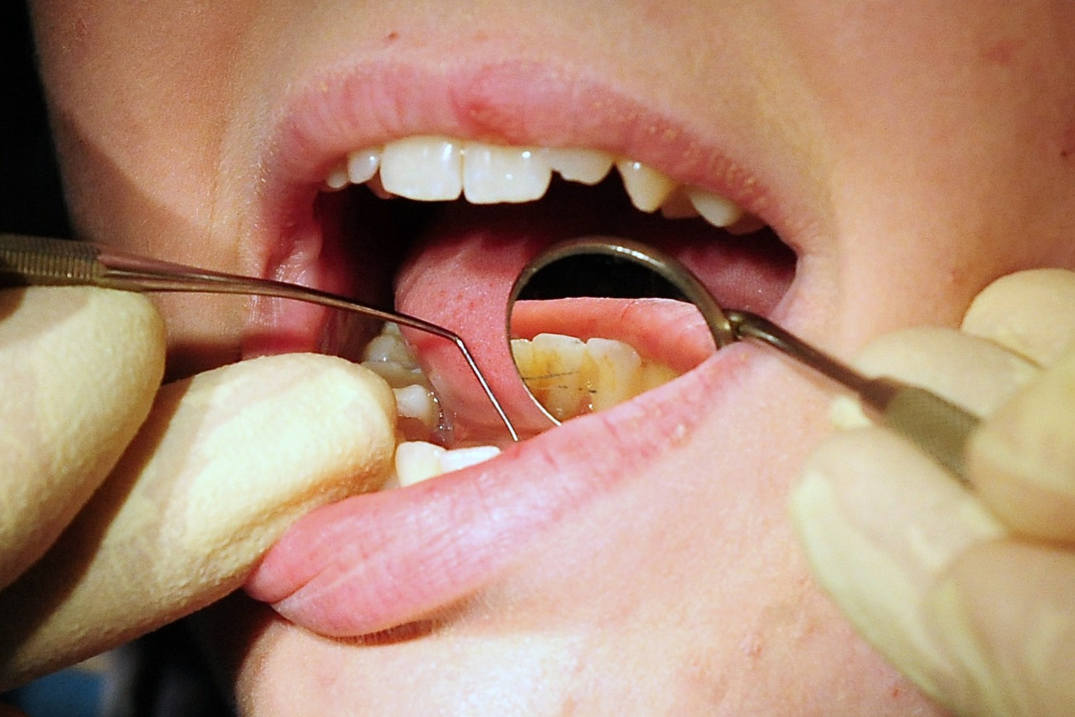 People forced to pull out their own teeth amid NHS dental crisis 