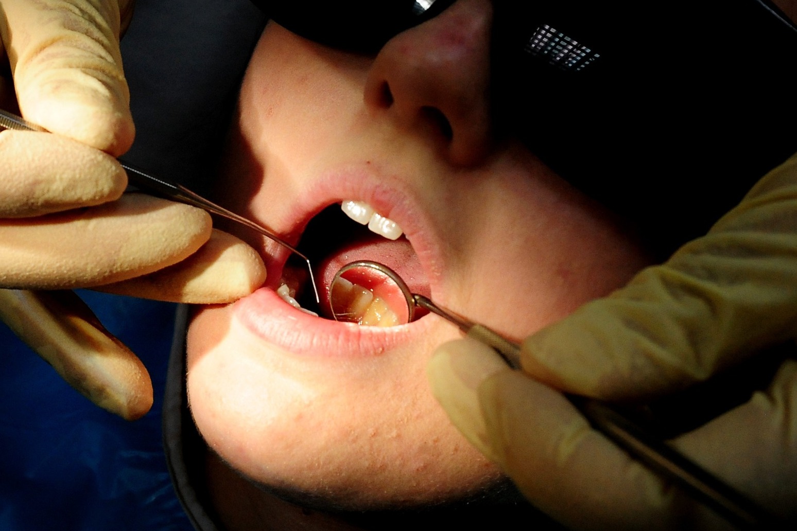 Tooth decay in children costing the NHS more than £40m a year 