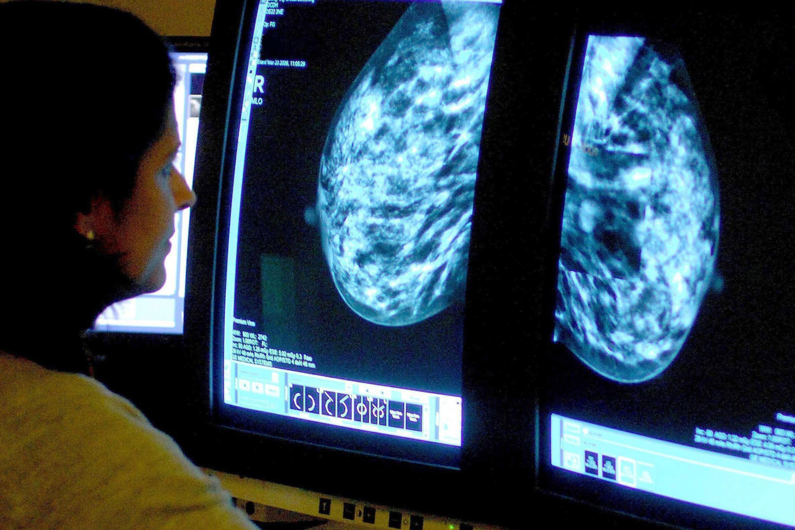 Younger women could be more prone to breast cancer spread 