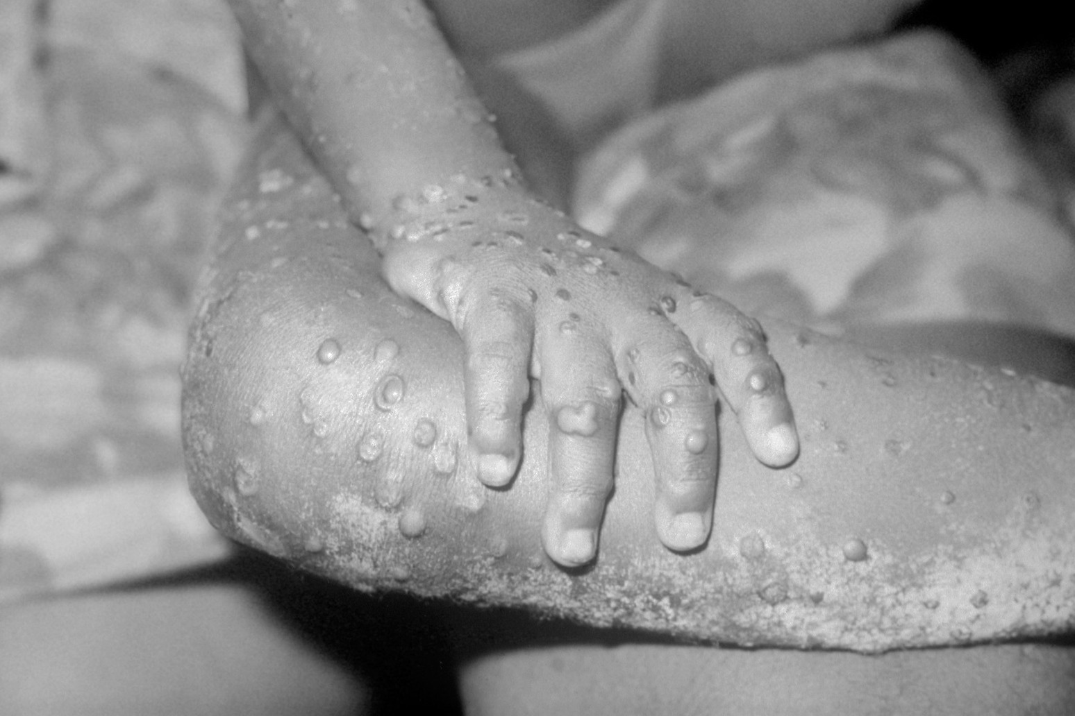 Medics must alert health authorities to monkeypox cases by law UKHSA says