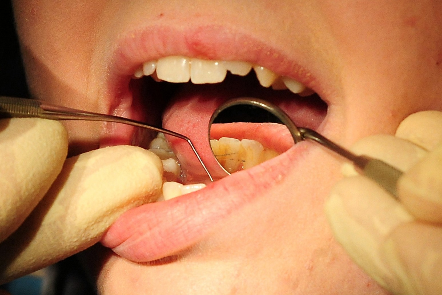 NHS dentistry ‘at tipping point’ with warning that patients will ‘pay the price’ 
