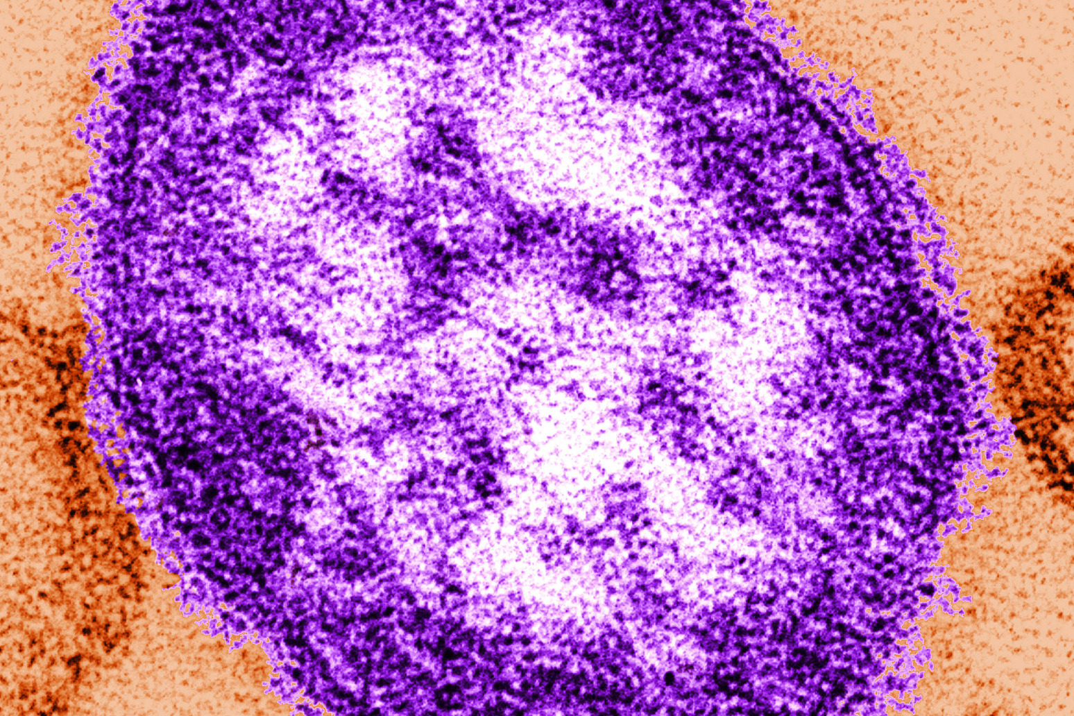 Measles fears after vaccine concerns 